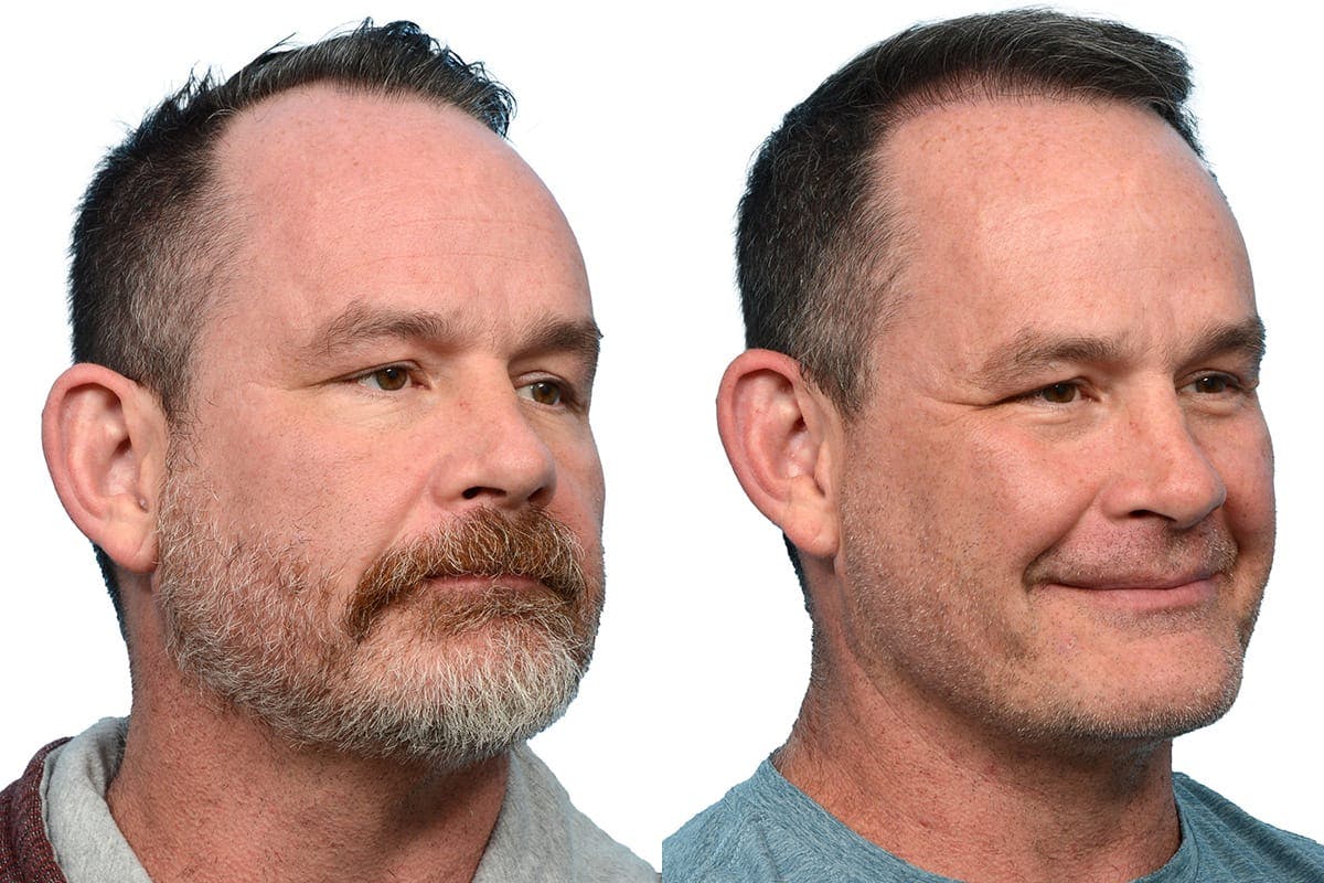 Hair Restoration Before & After Gallery - Patient 426609 - Image 2