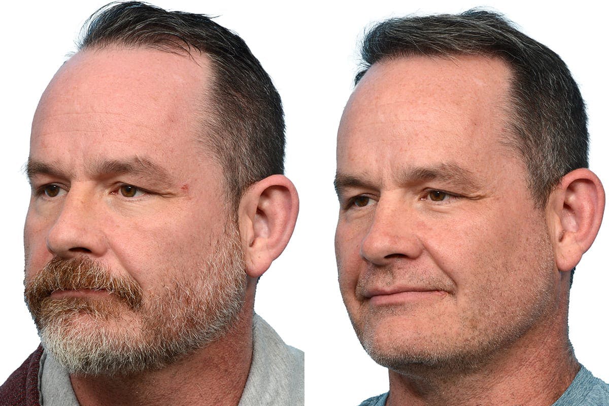 FUE Hair Transplant Before & After Gallery - Patient 215711 - Image 3