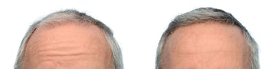 FUE Hair Transplant Before & After Gallery - Patient 379539 - Image 1