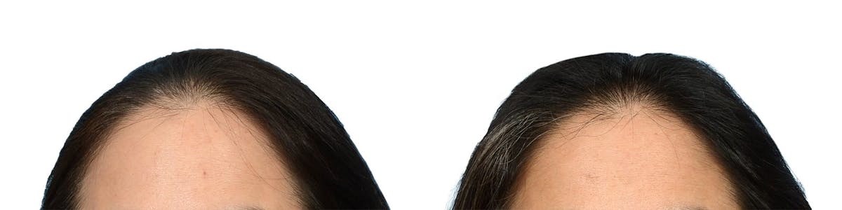 Female Hair Restoration Before & After Gallery - Patient 288793 - Image 1