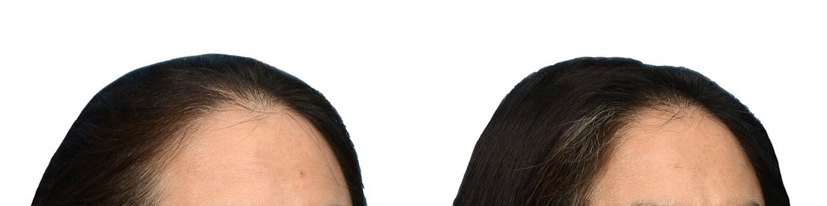 Female Hair Restoration Before & After Gallery - Patient 288793 - Image 2