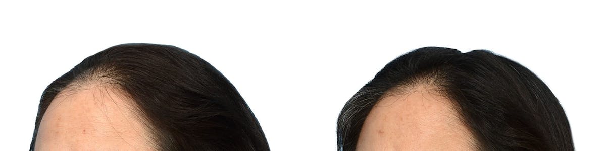 Hair Restoration Before & After Gallery - Patient 293932 - Image 3