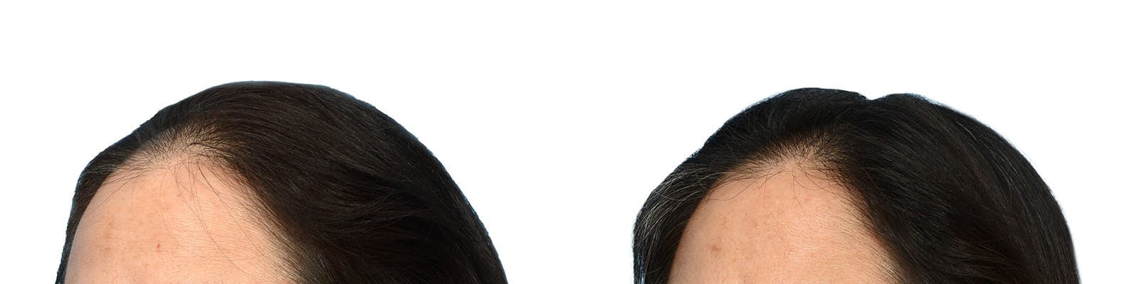 Hair Restoration  Before & After Gallery - Patient 293932 - Image 3