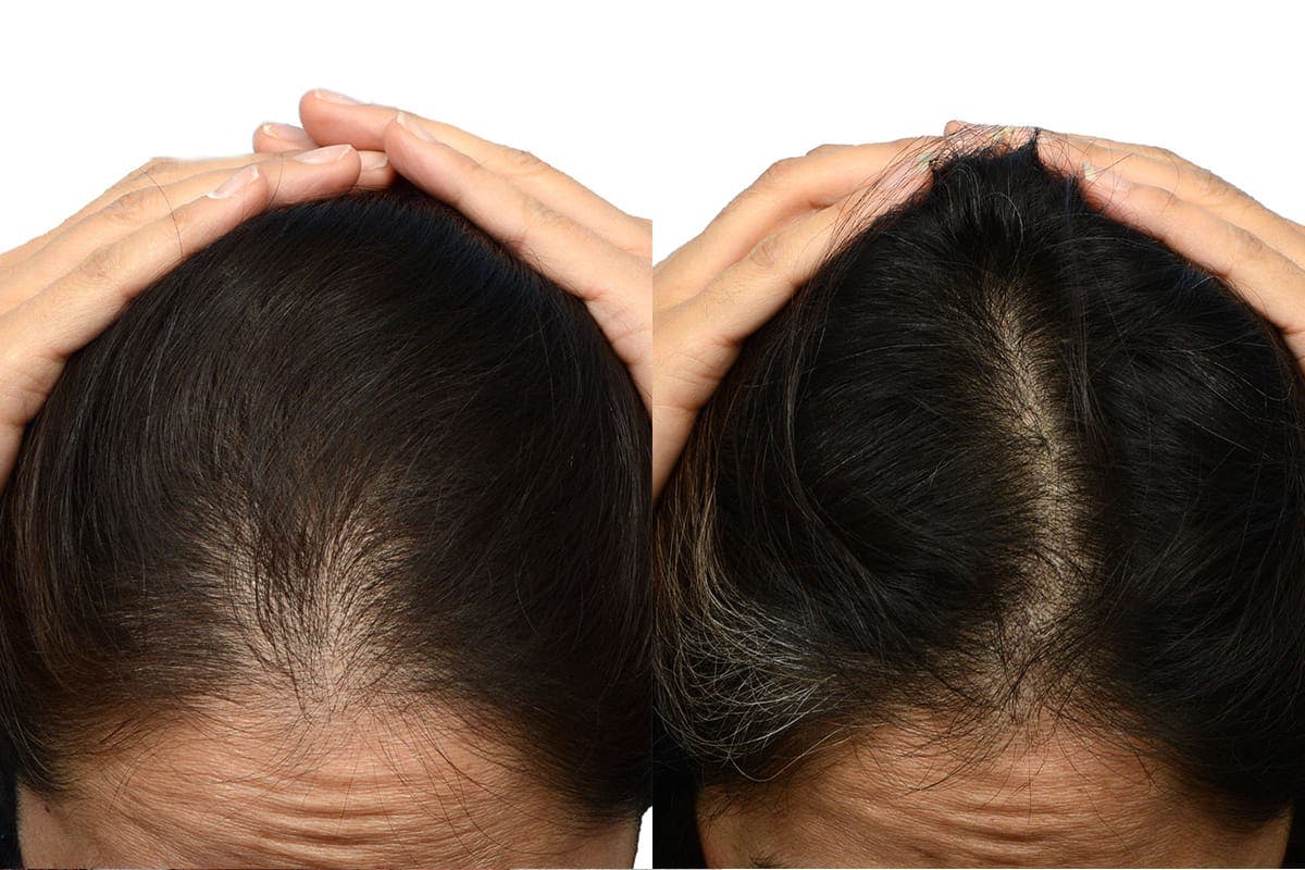 Female Hair Restoration Before & After Gallery - Patient 288793 - Image 4