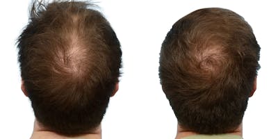 Hair Restoration Before & After Gallery - Patient 105295 - Image 1