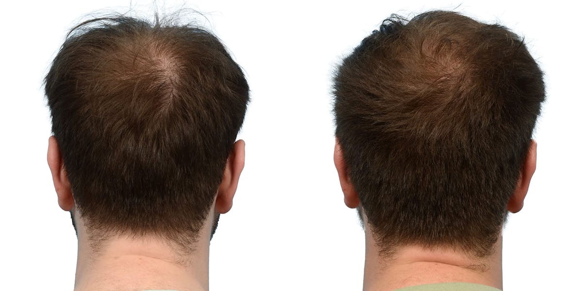 Hair Restoration Before & After Gallery - Patient 105295 - Image 2