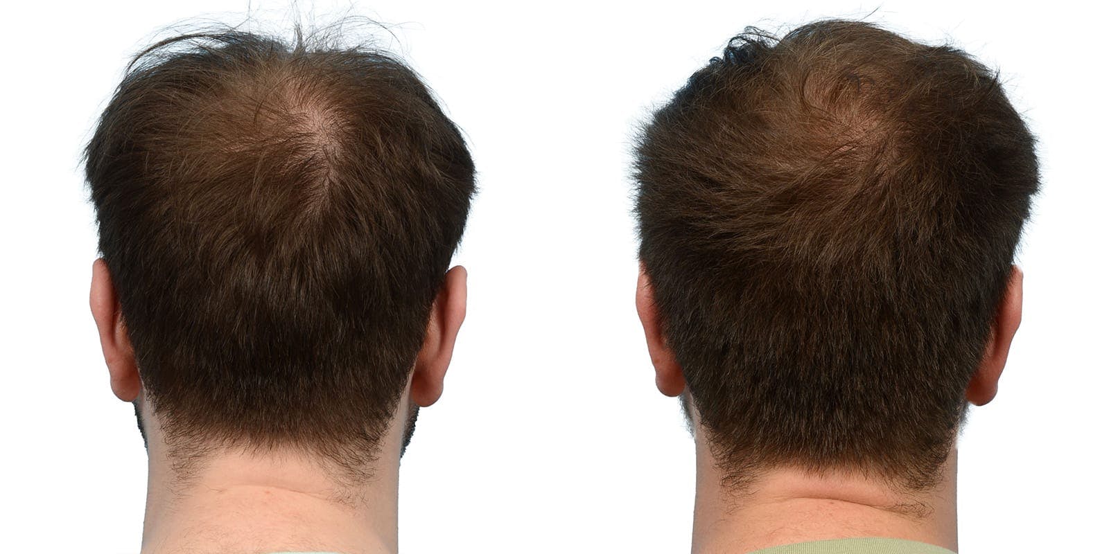 Hair Restoration  Before & After Gallery - Patient 105295 - Image 2
