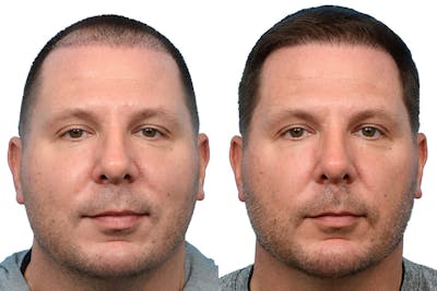 Hair Restoration Before & After Gallery - Patient 448033 - Image 1