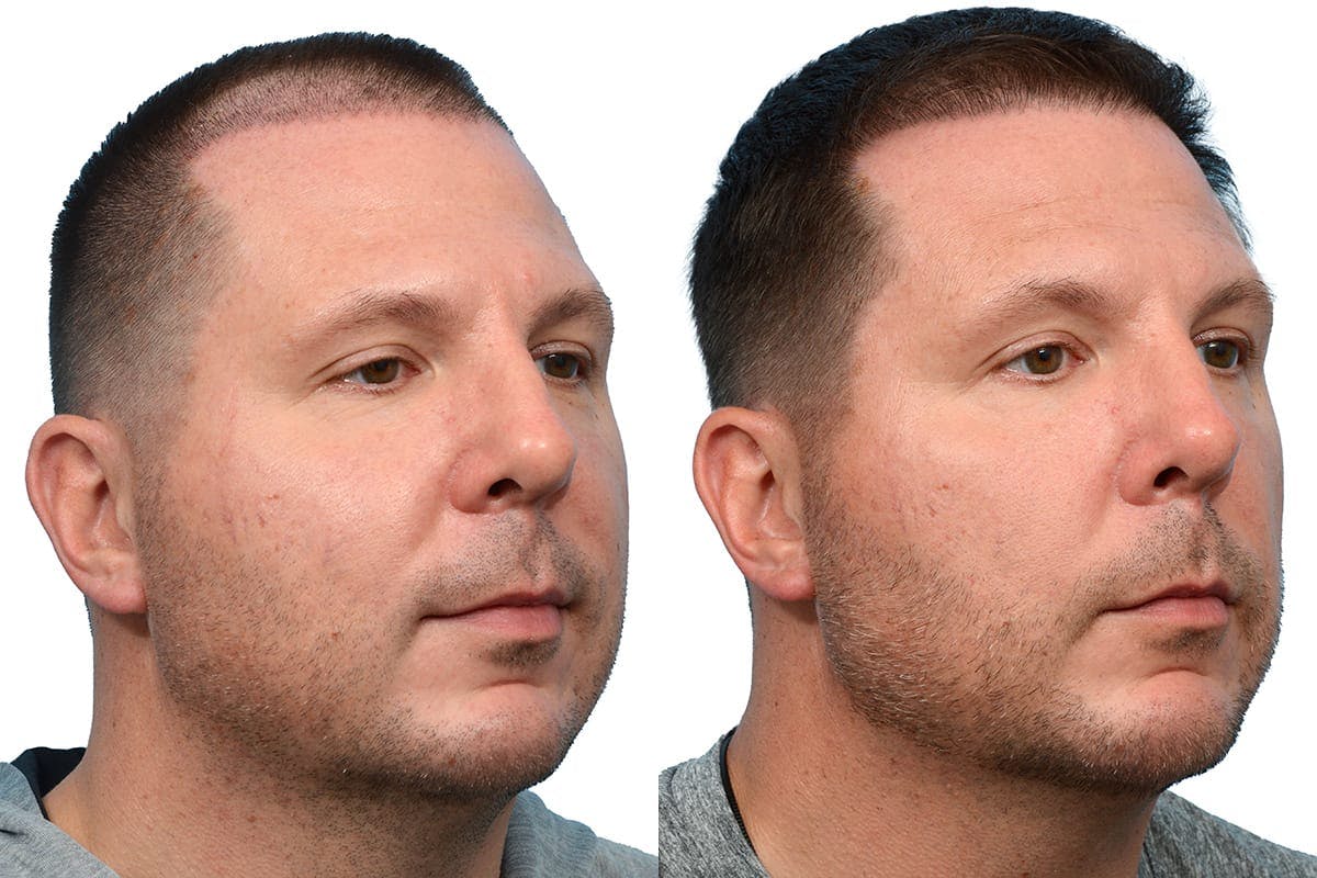 FUE Hair Transplant Before & After Gallery - Patient 168415 - Image 2