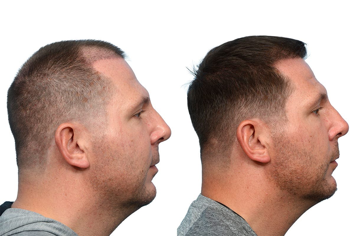 FUE Hair Transplant Before & After Gallery - Patient 168415 - Image 3