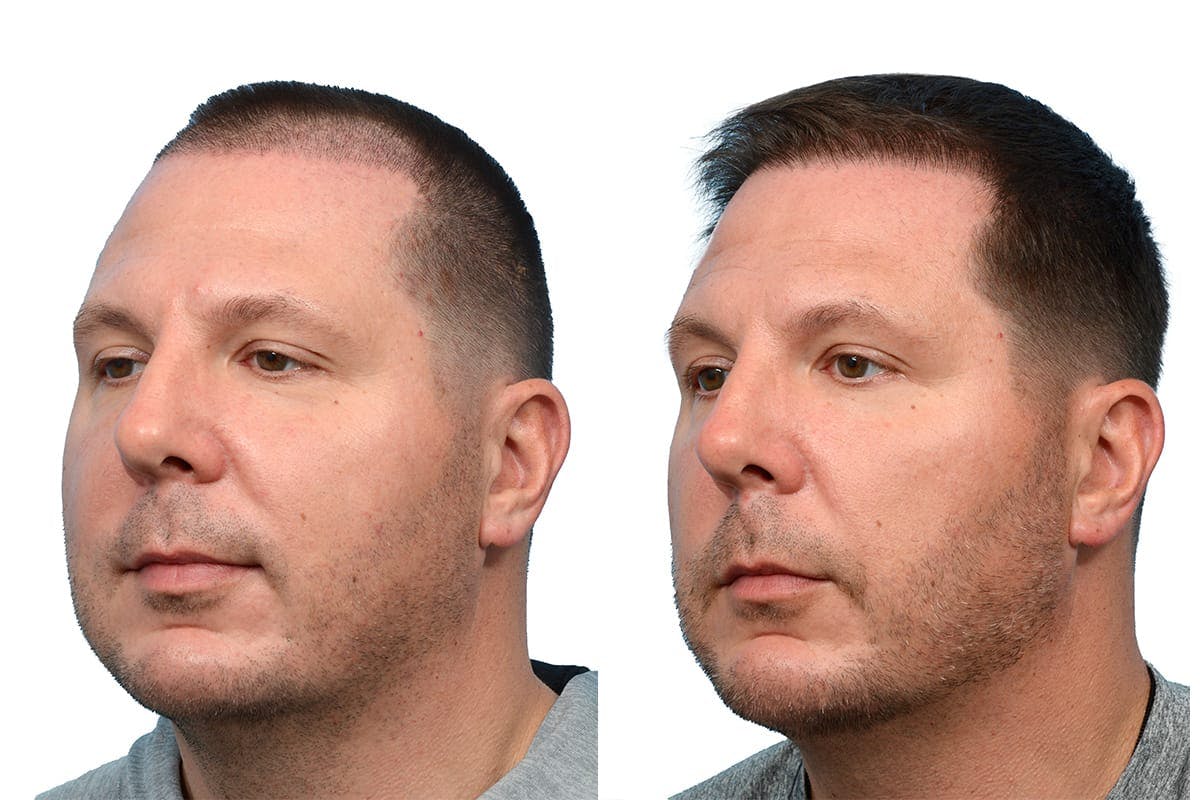 FUE Hair Transplant Before & After Gallery - Patient 168415 - Image 4