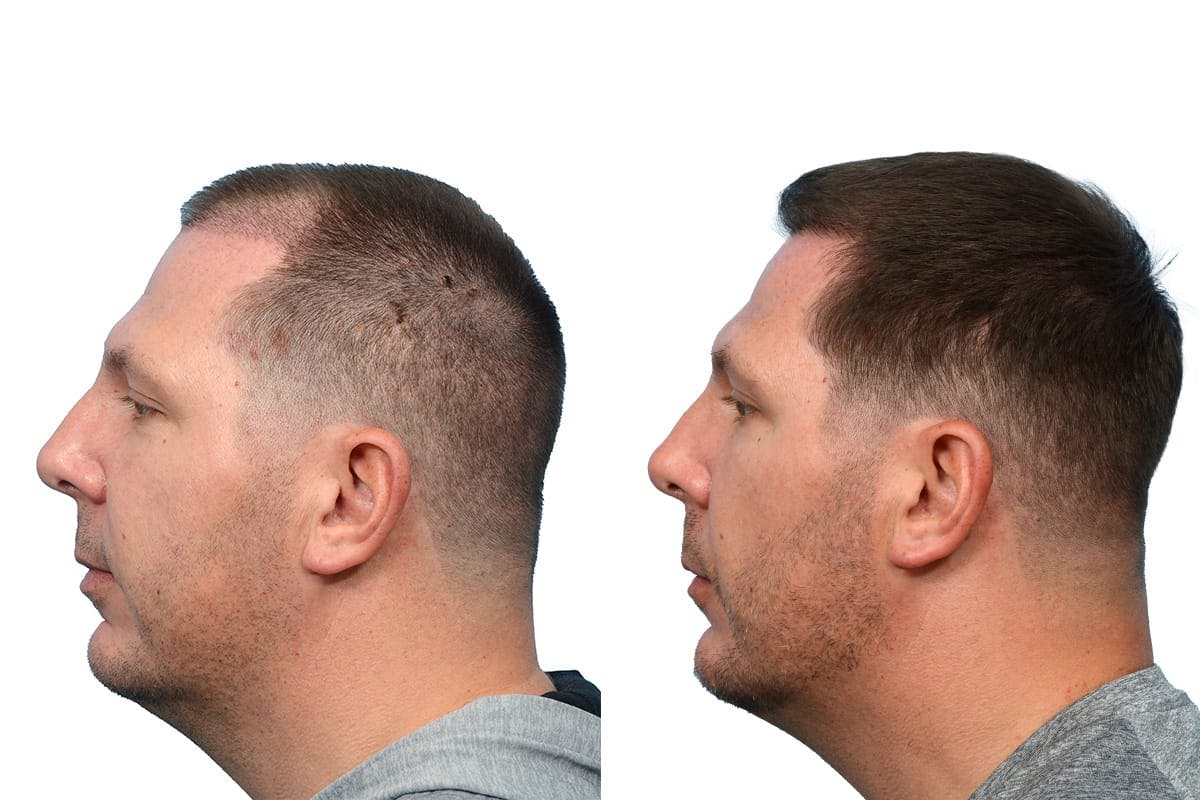 Hair Restoration Before & After Gallery - Patient 448033 - Image 5