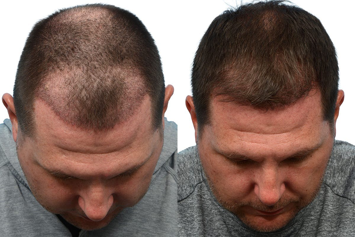 FUE Hair Transplant Before & After Gallery - Patient 168415 - Image 6