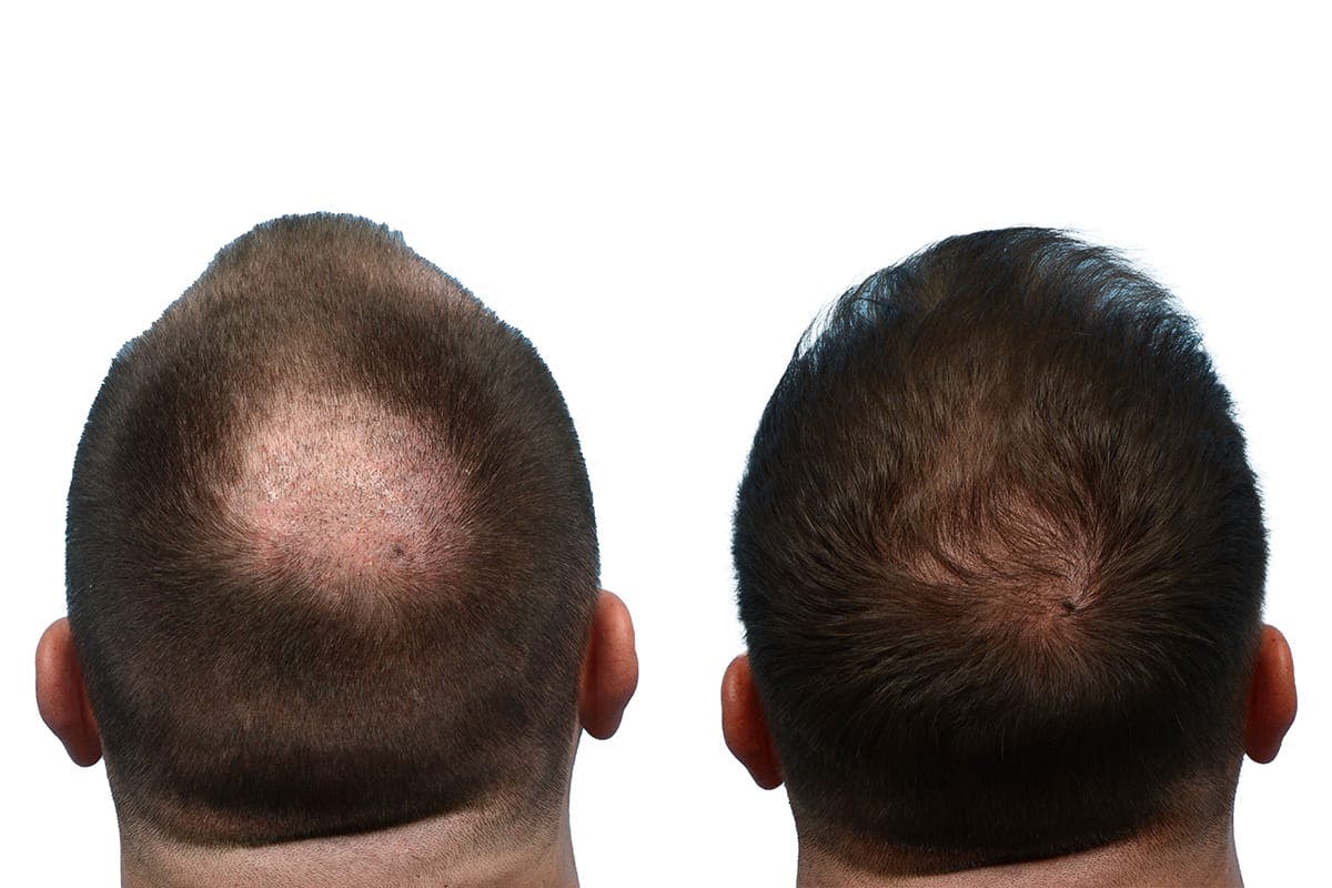 Hair Restoration Before & After Gallery - Patient 448033 - Image 7