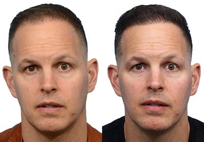 FUE Hair Transplant Before & After Gallery - Patient 180165 - Image 1