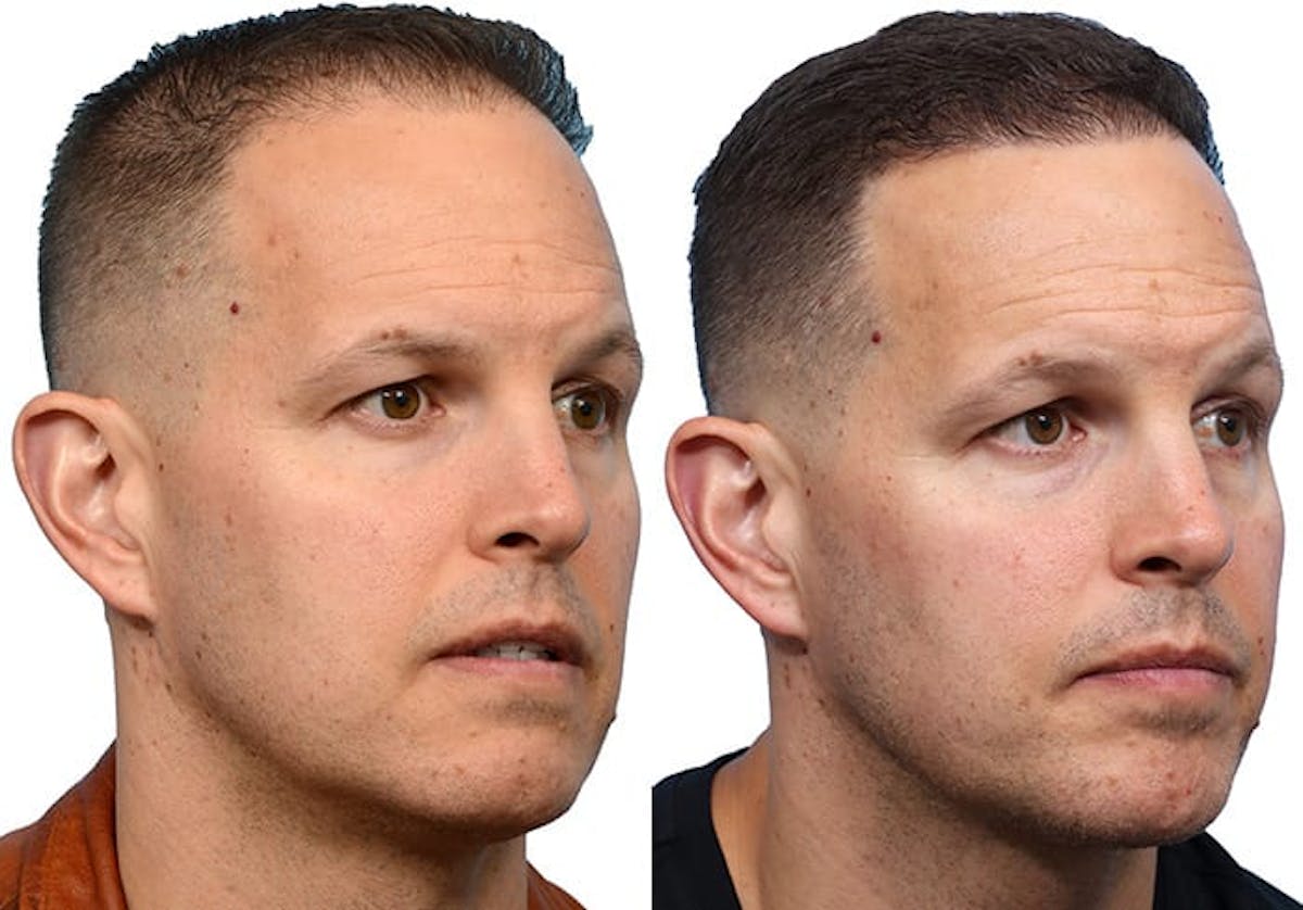 FUE Hair Transplant Before & After Gallery - Patient 180165 - Image 2