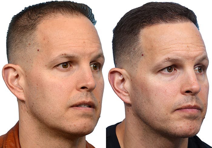 Hair Restoration  Before & After Gallery - Patient 293669 - Image 2