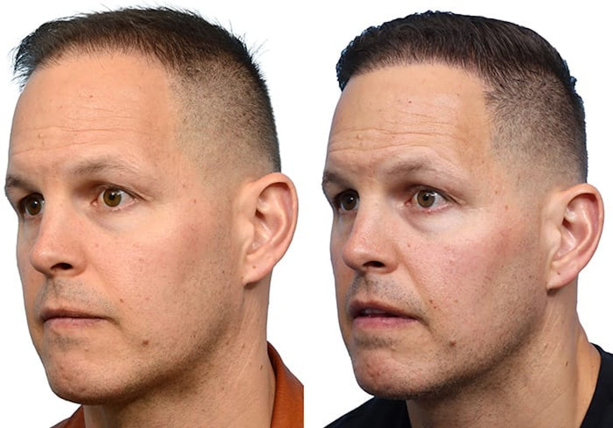 FUE Hair Transplant Before & After Gallery - Patient 180165 - Image 3