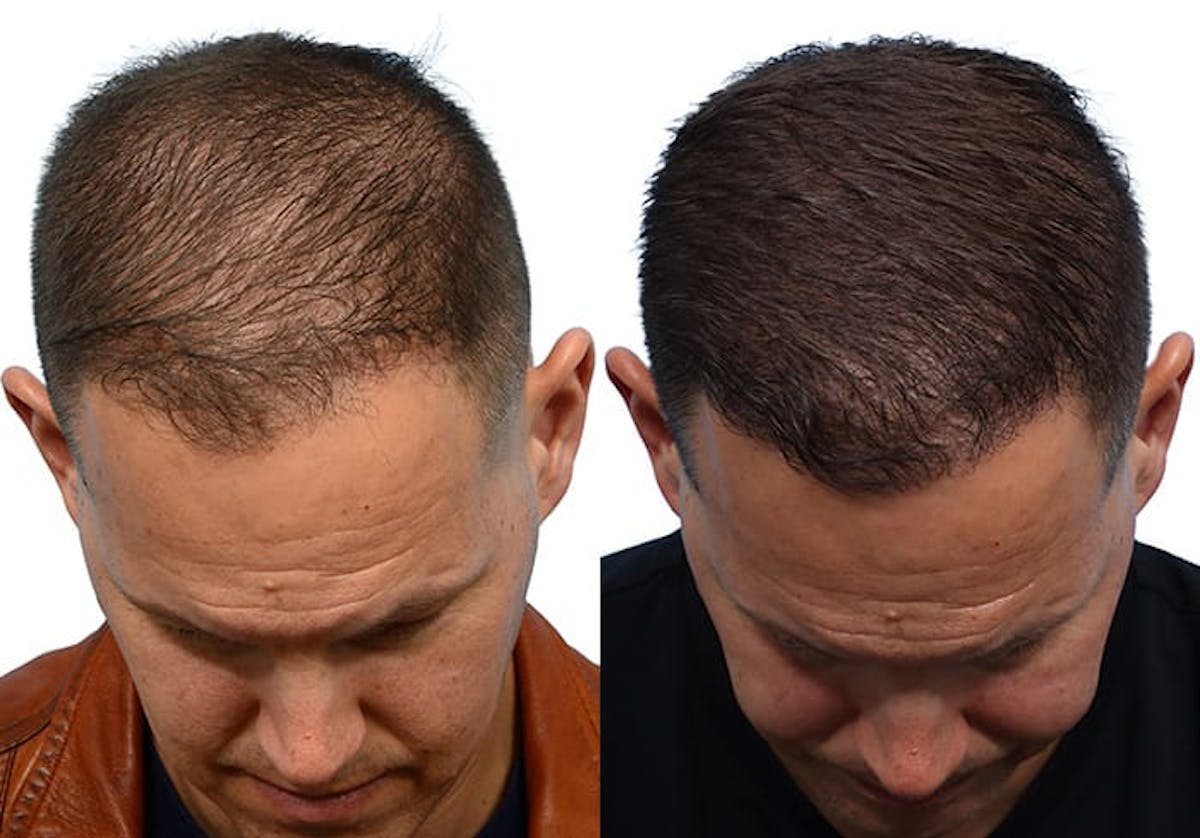 FUE Hair Transplant Before & After Gallery - Patient 180165 - Image 4