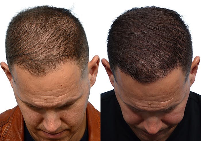 Hair Restoration  Before & After Gallery - Patient 293669 - Image 4