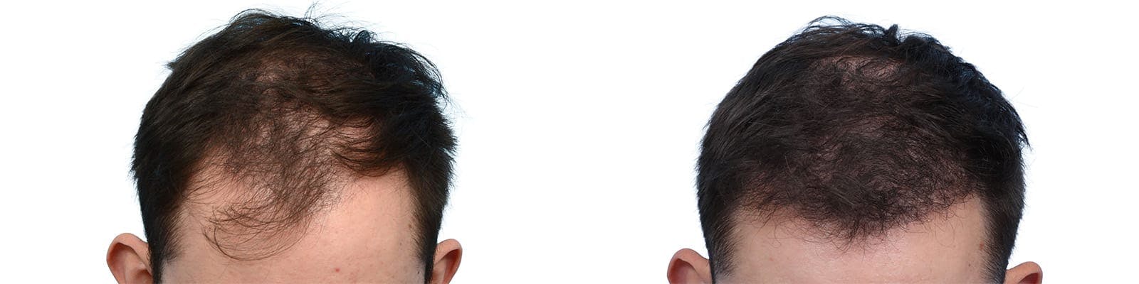 Hair Restoration  Before & After Gallery - Patient 221512 - Image 1