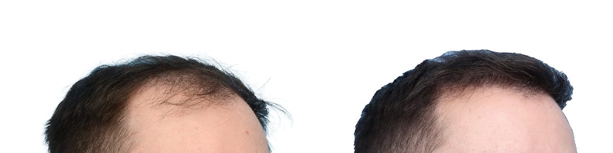 FUE Hair Transplant Before & After Gallery - Patient 123730 - Image 2