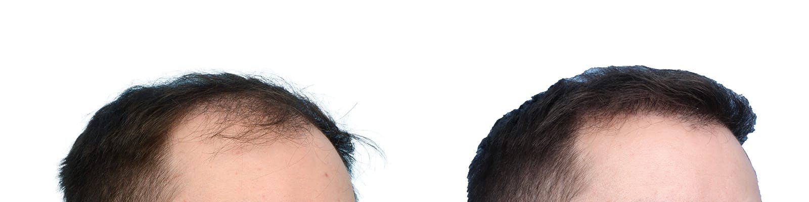 Hair Restoration  Before & After Gallery - Patient 221512 - Image 2