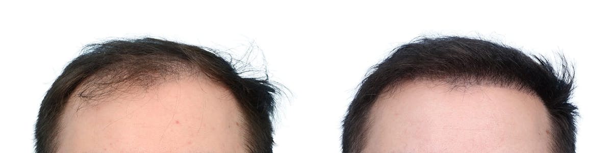 Hair Restoration Before & After Gallery - Patient 221512 - Image 3