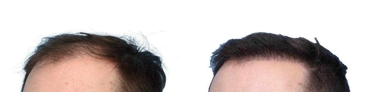 Hair Restoration Before & After Gallery - Patient 221512 - Image 4