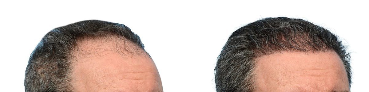 FUE Hair Transplant Before & After Gallery - Patient 353543 - Image 3