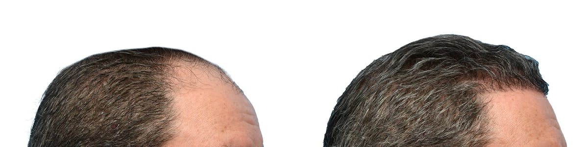 FUE Hair Transplant Before & After Gallery - Patient 353543 - Image 4