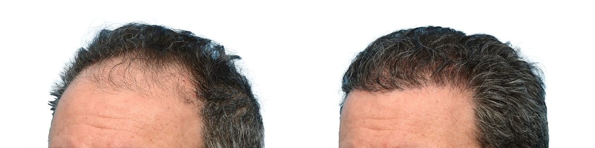 FUE Hair Transplant Before & After Gallery - Patient 353543 - Image 5