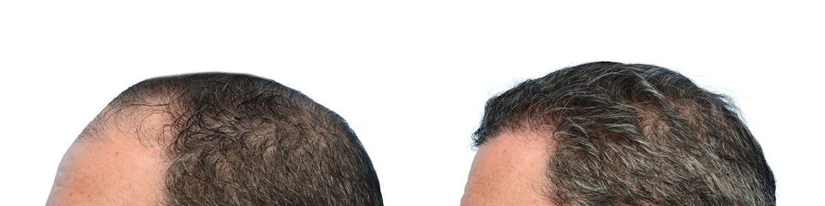 FUE Hair Transplant Before & After Gallery - Patient 353543 - Image 6