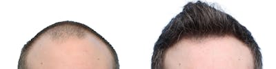 FUE Hair Transplant Before & After Gallery - Patient 970721 - Image 1