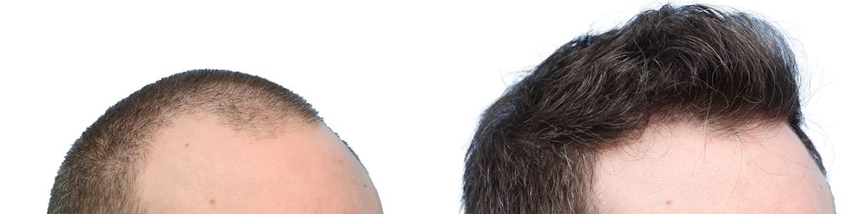 FUE Hair Transplant Before & After Gallery - Patient 970721 - Image 2