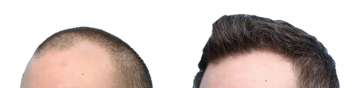 FUE Hair Transplant Before & After Gallery - Patient 970721 - Image 3