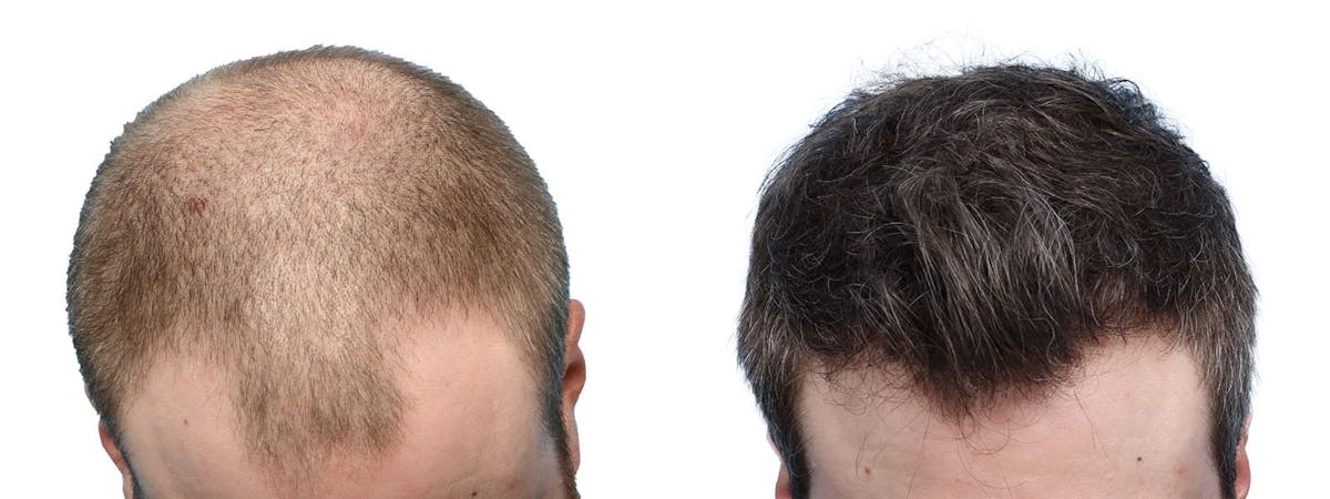 FUE Hair Transplant Before & After Gallery - Patient 970721 - Image 4