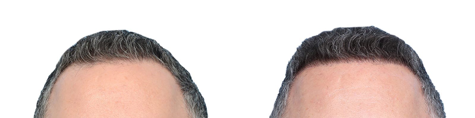 Hair Restoration  Before & After Gallery - Patient 185303 - Image 1