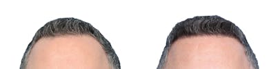 FUE Hair Transplant Before & After Gallery - Patient 398616 - Image 1
