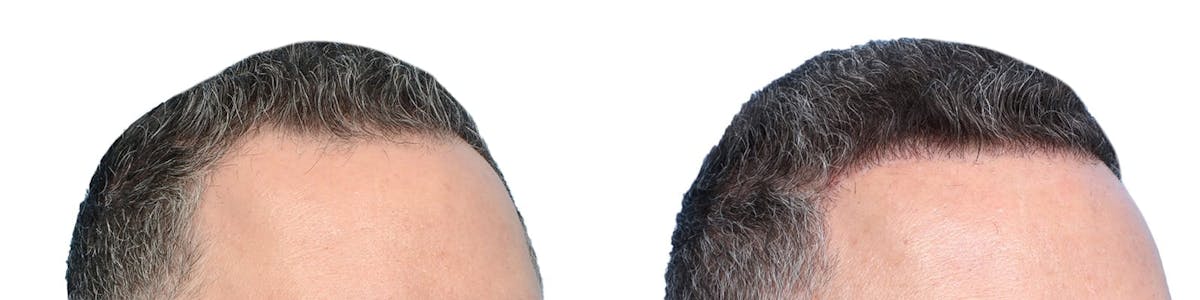 Hair Restoration Before & After Gallery - Patient 185303 - Image 2