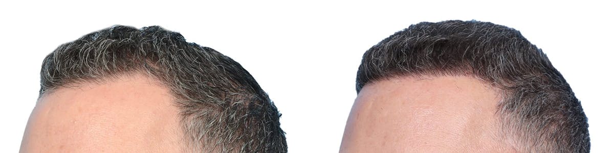 Hair Restoration Before & After Gallery - Patient 185303 - Image 3