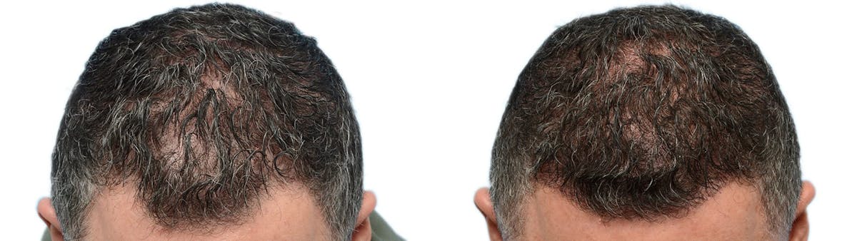 Hair Restoration Before & After Gallery - Patient 185303 - Image 4