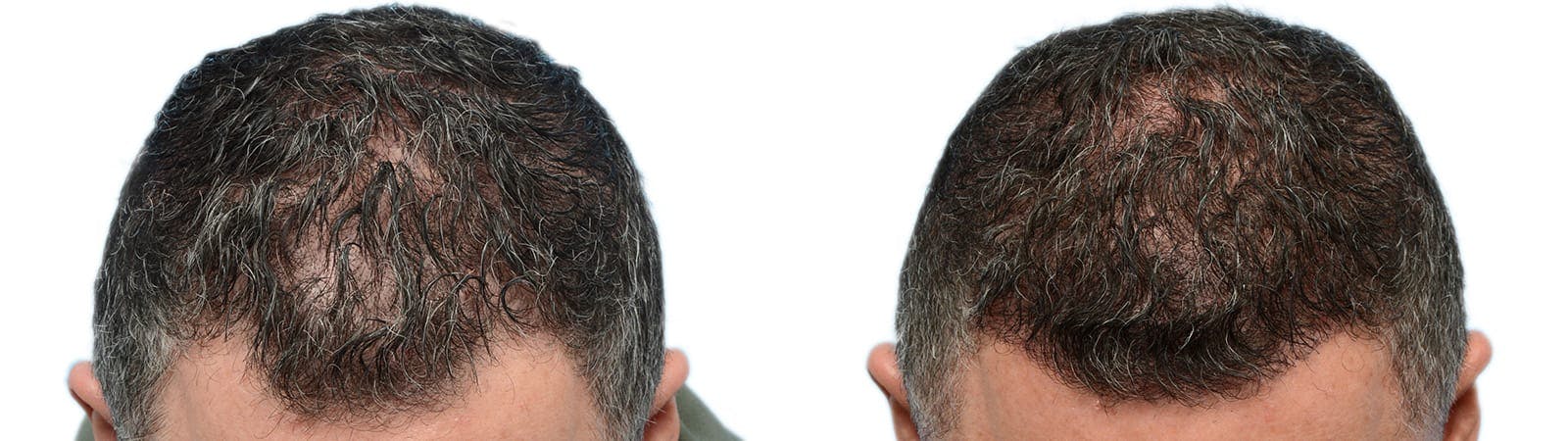 Hair Restoration  Before & After Gallery - Patient 185303 - Image 4