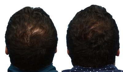 Platelet-Rich-Plasma Before & After Gallery - Patient 243796 - Image 1