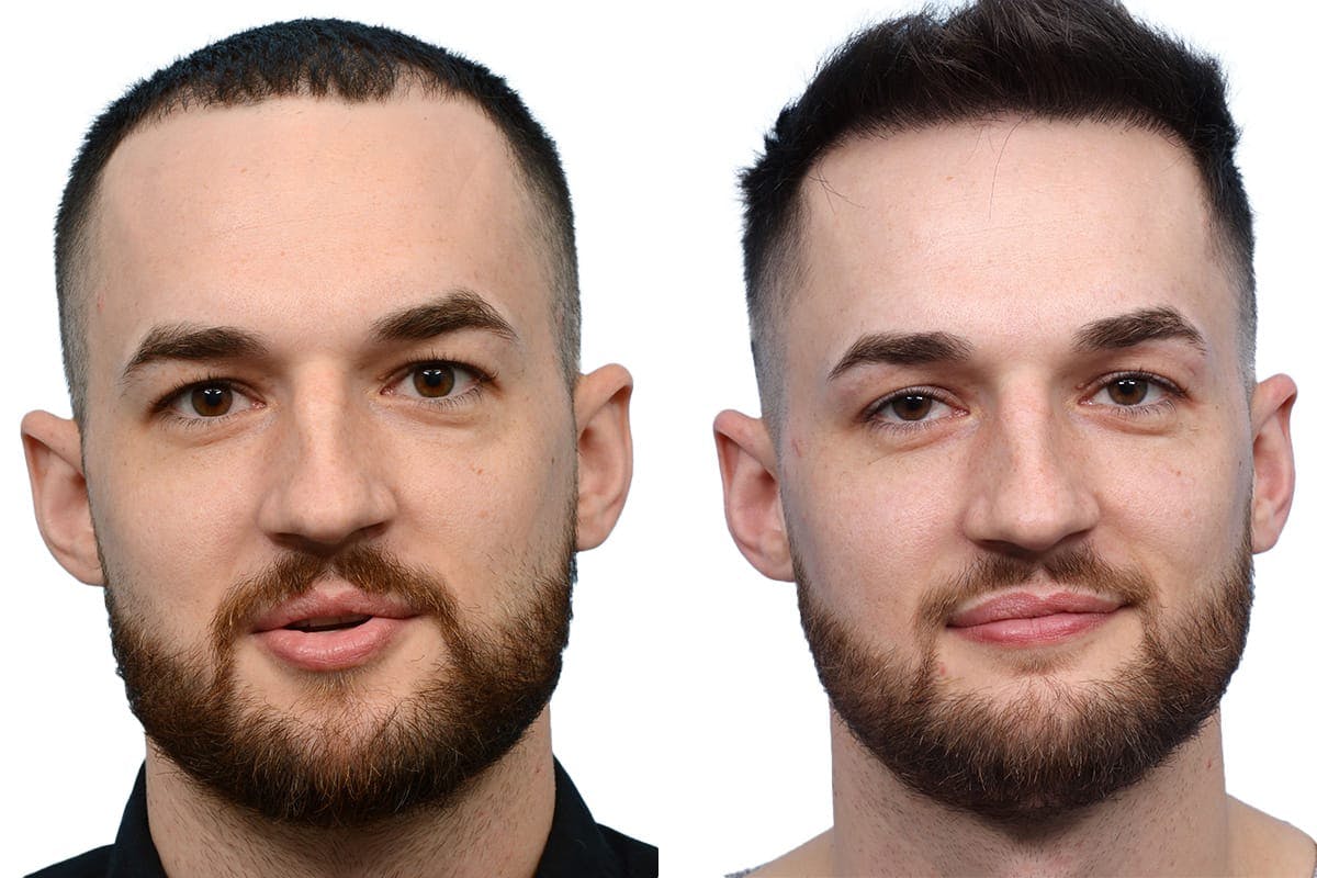 Hair Restoration Before & After Gallery - Patient 127666 - Image 2
