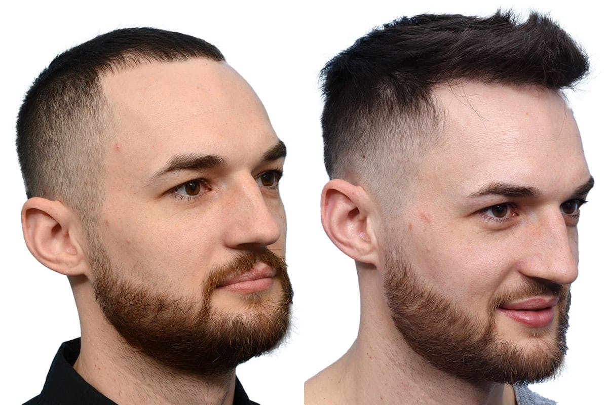 FUE Hair Transplant Before & After Gallery - Patient 667358 - Image 3