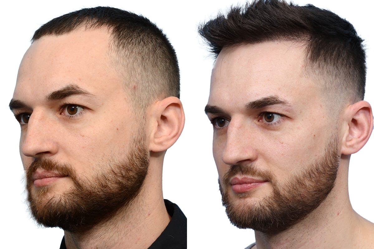 FUE Hair Transplant Before & After Gallery - Patient 667358 - Image 4