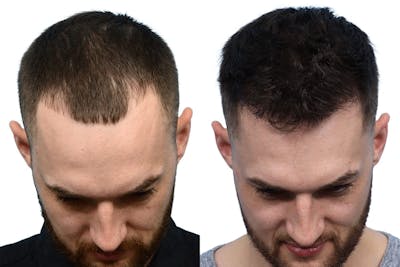 FUE Hair Transplant Before & After Gallery - Patient 667358 - Image 1