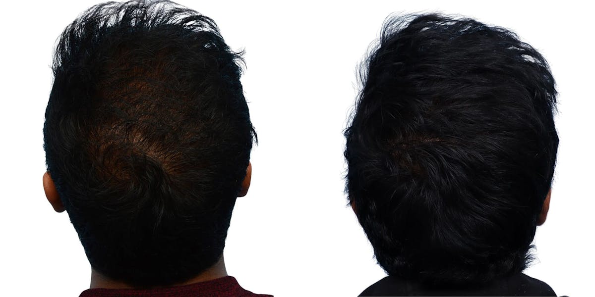 Hair Restoration Before & After Gallery - Patient 106901 - Image 1