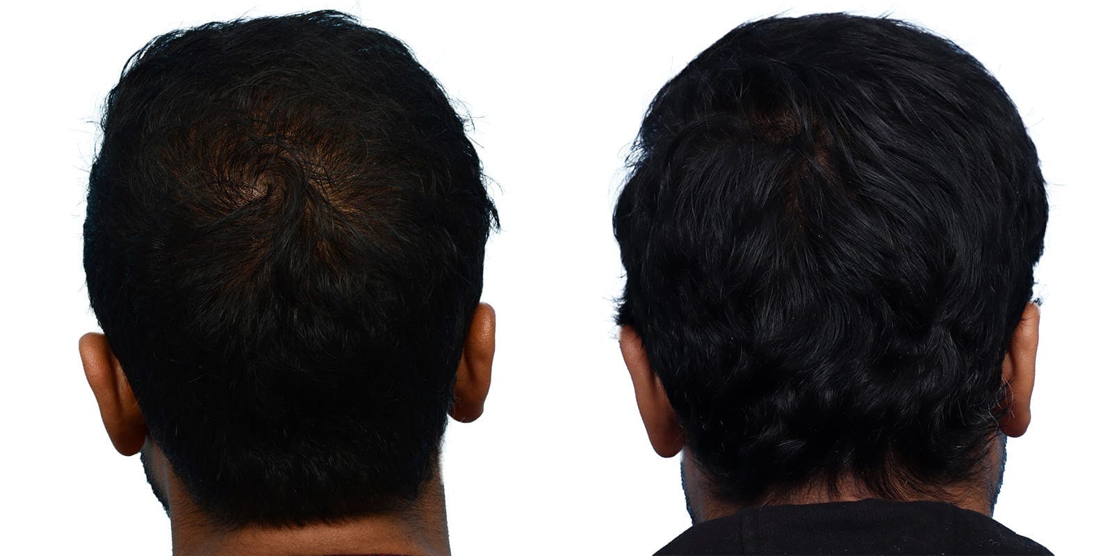 Hair Restoration  Before & After Gallery - Patient 106901 - Image 2